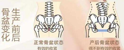 产后恢复 | 骨盆变形有什么症状？