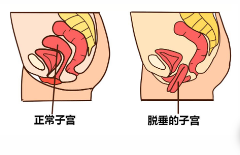 常见的产后康复项目，有哪些？