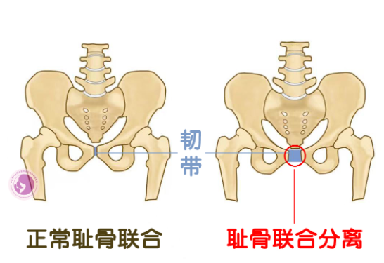 产后耻骨疼，到底还要忍多久？